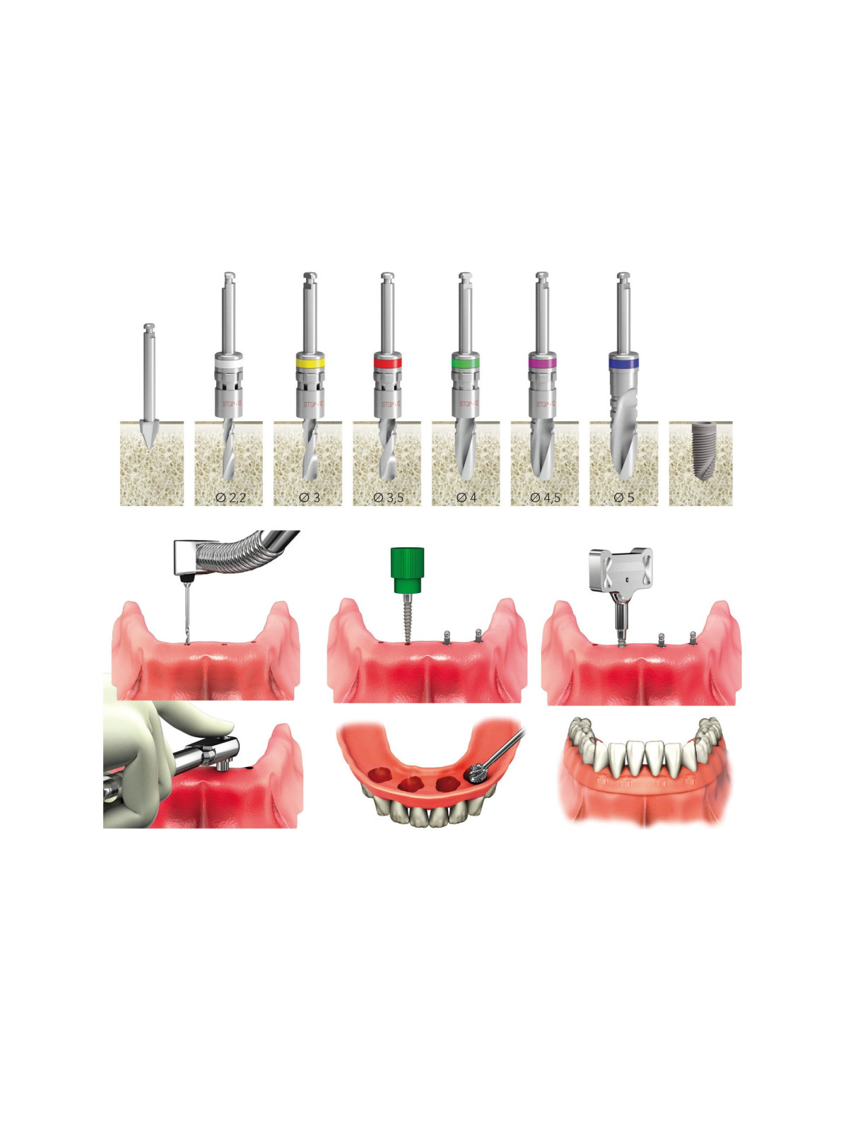 Wide-thread Mini Implantat