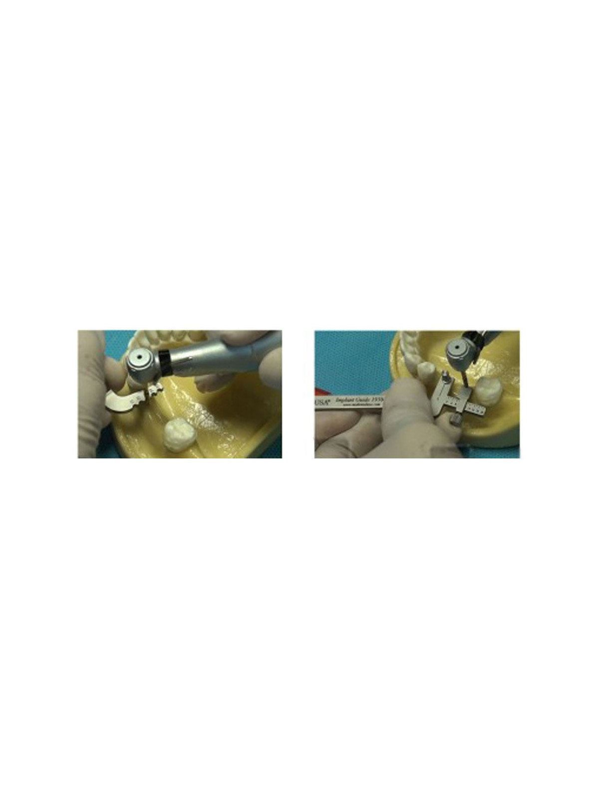 Implant Guide Kit